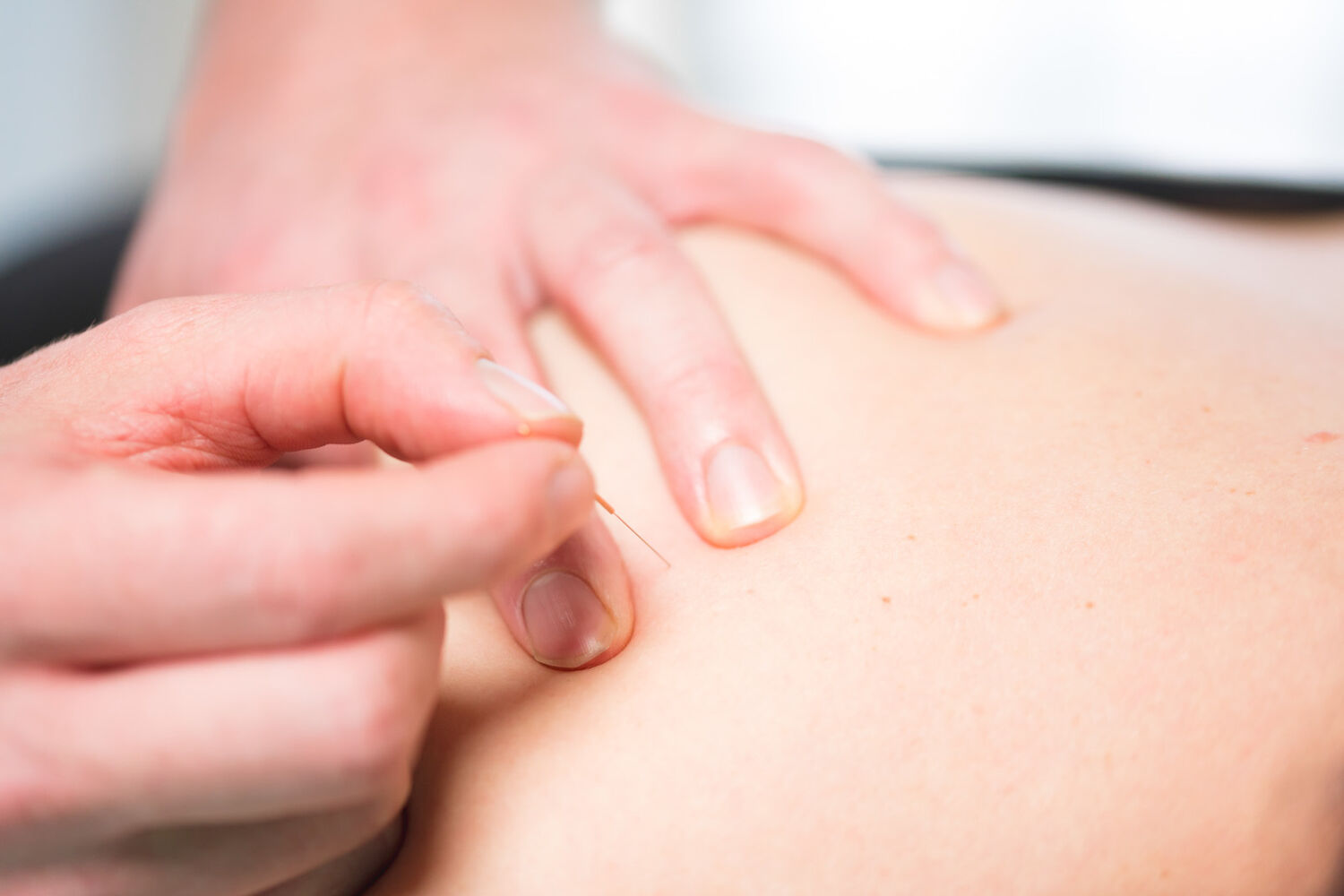dry needling enschede polman